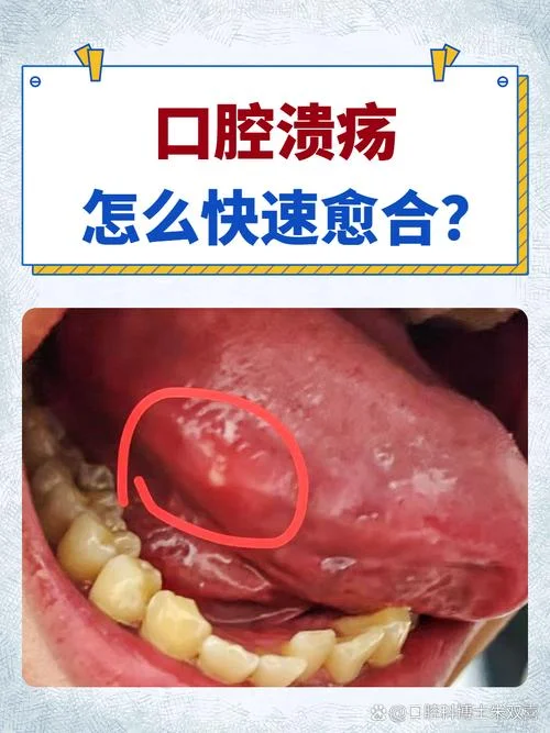 梦见自己口腔溃疡_2