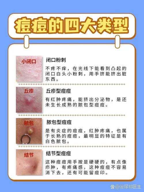 下巴爆痘是跟什么有关-下巴爆痘原因