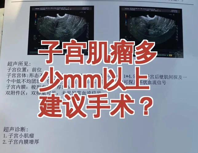 做子宫肌瘤要多少钱_1