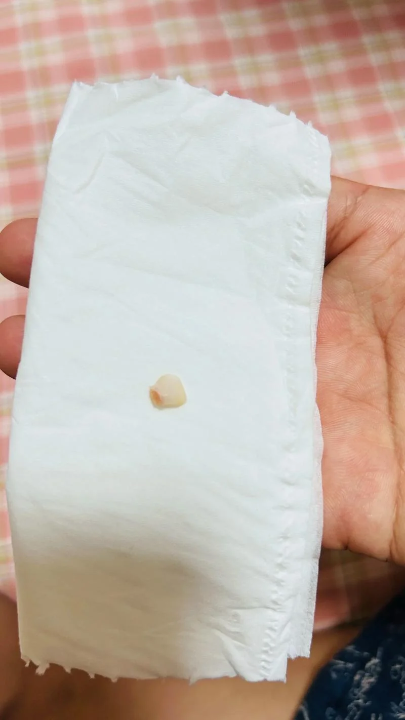 梦到自己门牙掉了-梦掉门牙