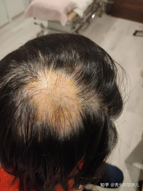 女梦见掉头发斑秃_2