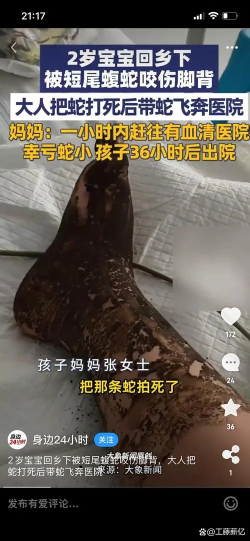 做梦梦到蛇啃自己的脚_2