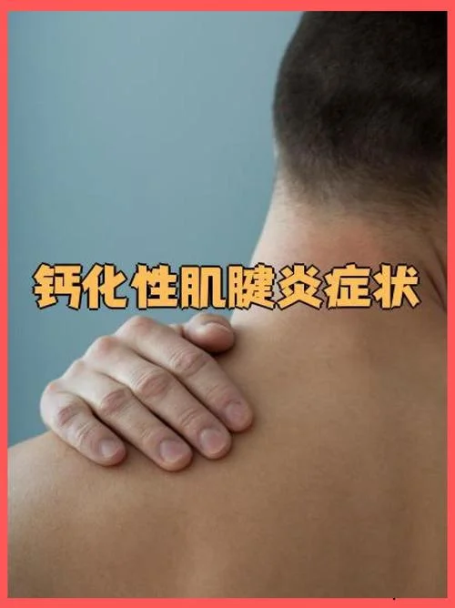 什么是钙化性肌腱炎_1