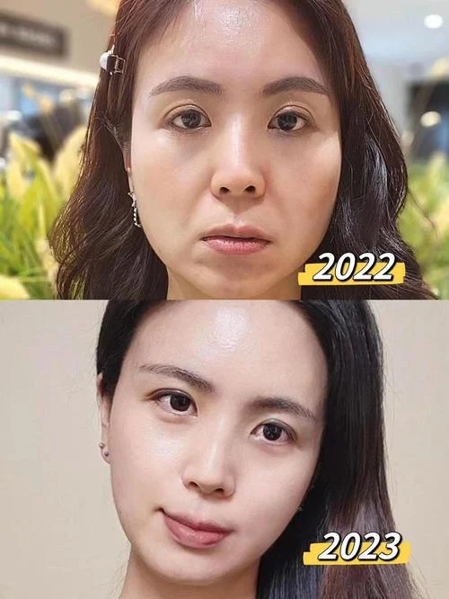 苹果肌整形多少钱_2