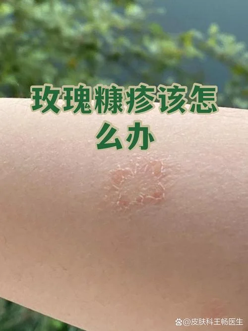 玫瑰糠疹是由什么原因引起的-玫瑰糠疹由病毒感染引起