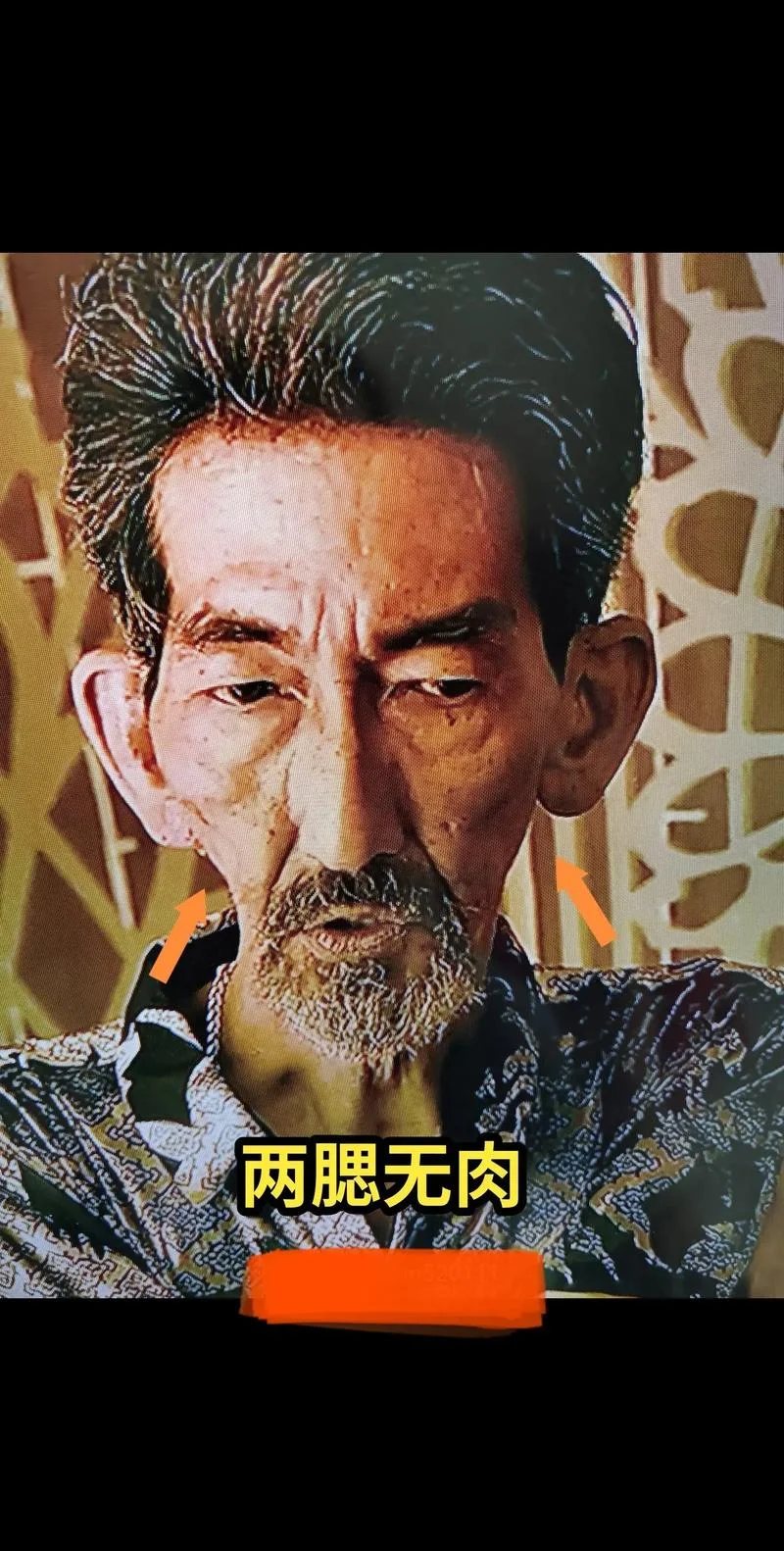 尖嘴猴腮的面相-尖嘴猴腮面相