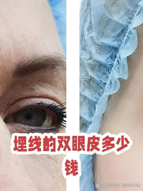 做个埋线多少钱_1
