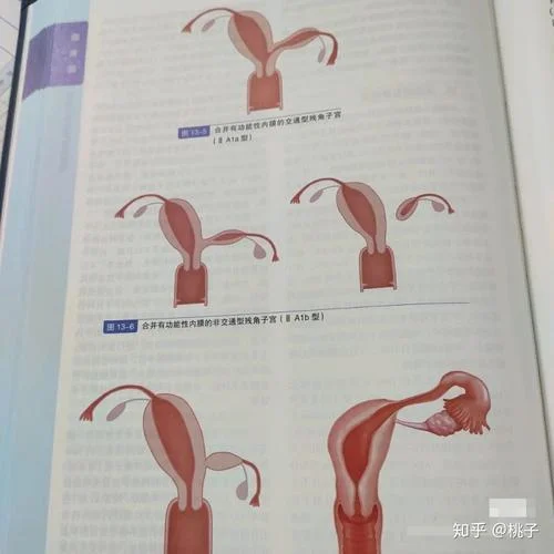 弓状宫腔什么意思_2