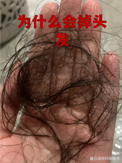 孕妇梦见自己掉头发-孕妇梦掉发