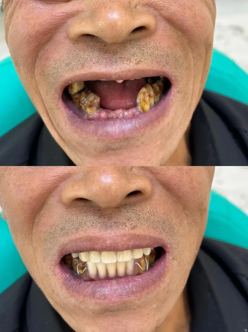 梦见自己假牙脱落_1