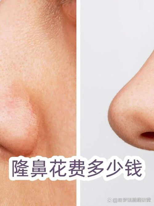 隆鼻的手术多少钱_1