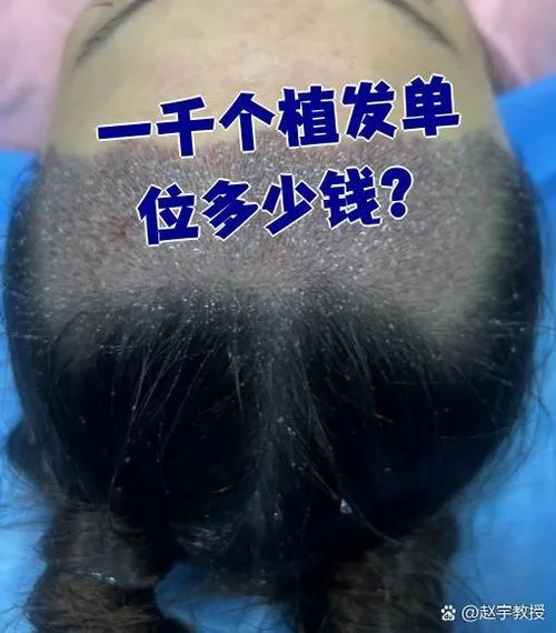 头皮植入毛囊多少钱_1