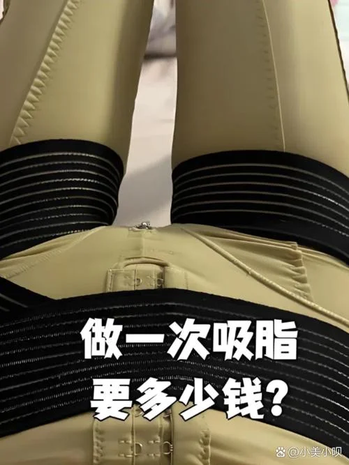 腰腹部抽脂多少钱_2