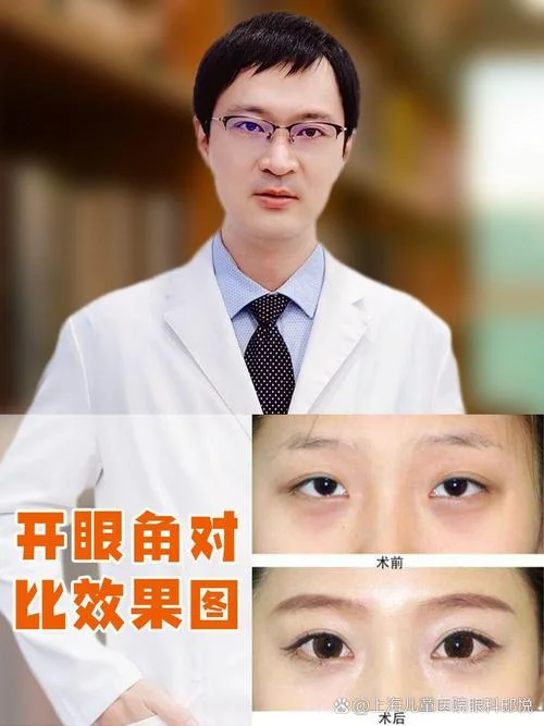 怎么做眼部整形手术-做眼部整形手术