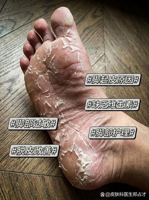 脚脱皮是有什么原因-脚脱皮原因探究