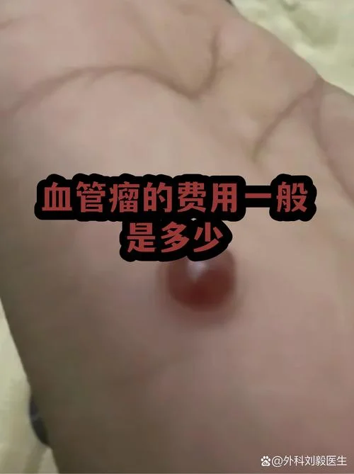 治疗血管瘤要多少钱_1