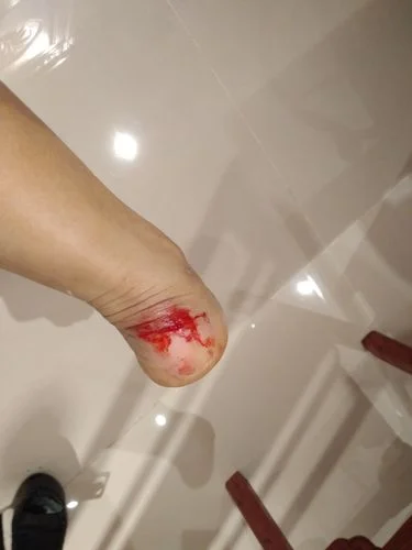 梦见脚上流血是什么意思?_2