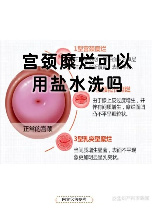 宫颈糜烂治好要多少钱_1
