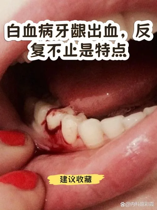 梦见牙龈出血会怎么样-梦牙龈出血何解