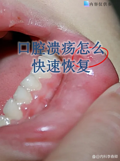 溃疡怎么读拼音怎么写_1
