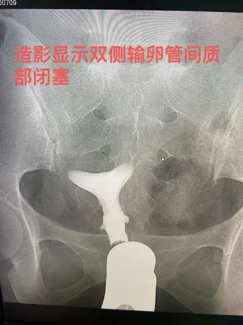 输卵管堵塞手术怎么做_2