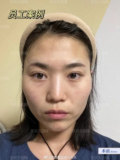 磨骨改脸型手术多少钱_1