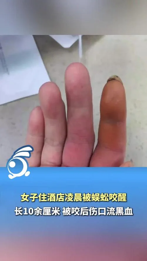 梦见大蜈蚣咬自己的手_2