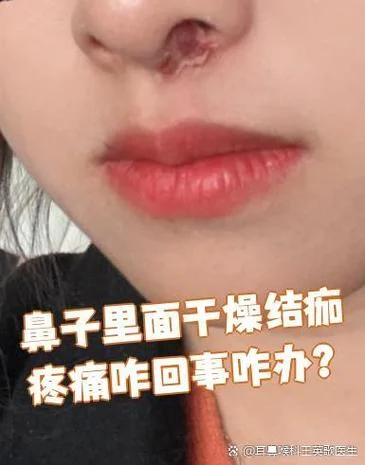 鼻子内壁红肿疼痛怎么办_1