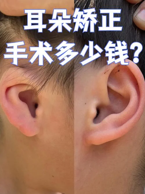 耳朵整形需要多少钱_2
