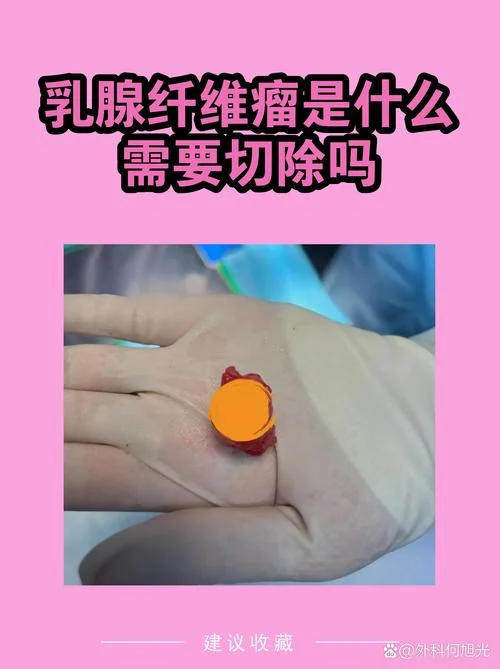 乳腺纤维留检查多少钱_1