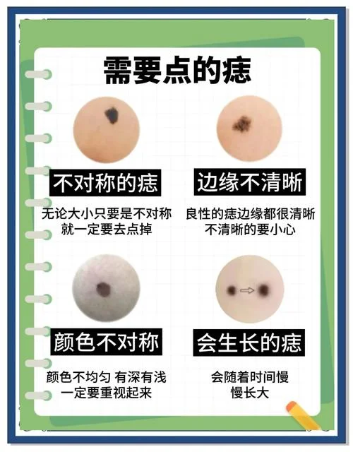 点肉痣需要多少钱一颗_1