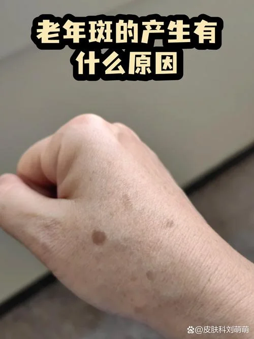 什么是老年斑-老年斑是什么