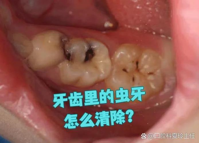 做梦梦见蛀牙牙虫子_1