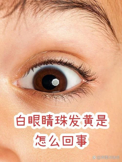 眼睛发黄是为什么-眼睛发黄原因