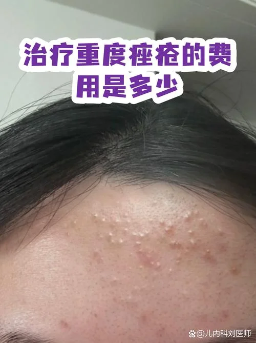 痘印治疗要多少钱_2