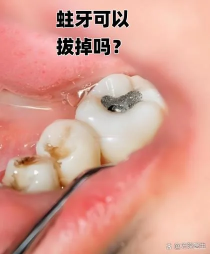 梦见掉了一颗蛀牙下牙_2