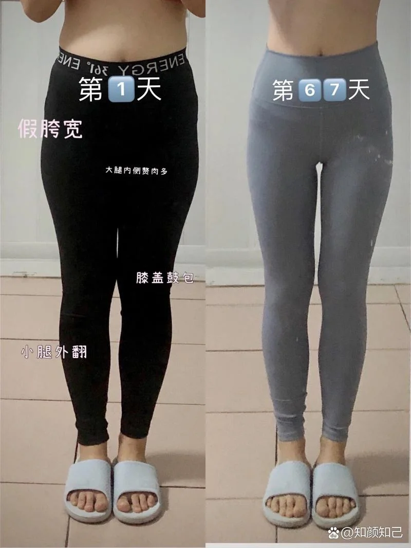 瘦腿得多少钱_1