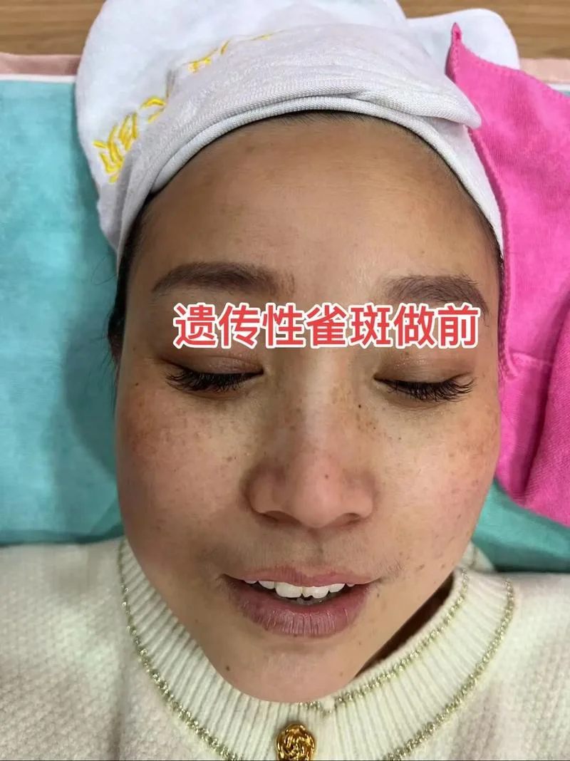 祛雀斑一般多少钱_1