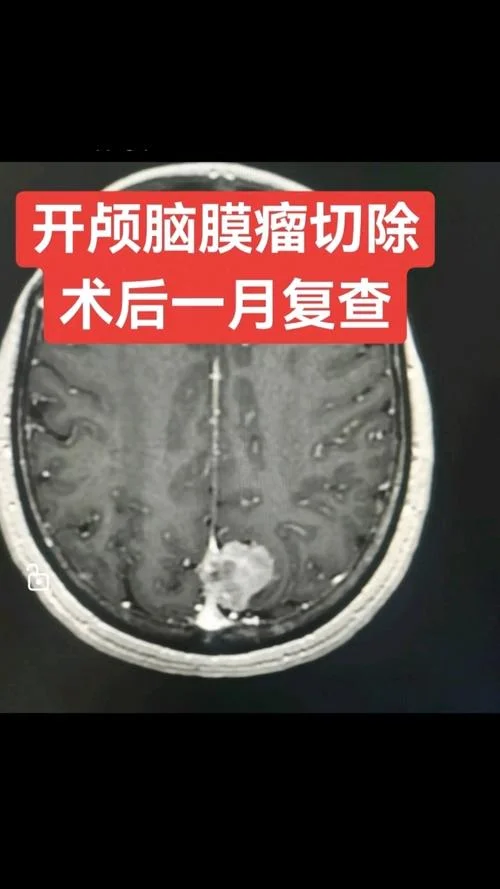 什么是脑膜瘤术后复发-脑膜瘤术后复发含义