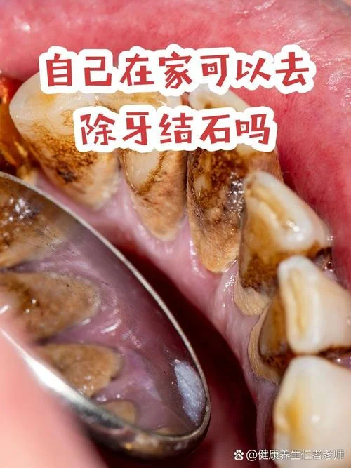 去一下牙结石多少钱_2