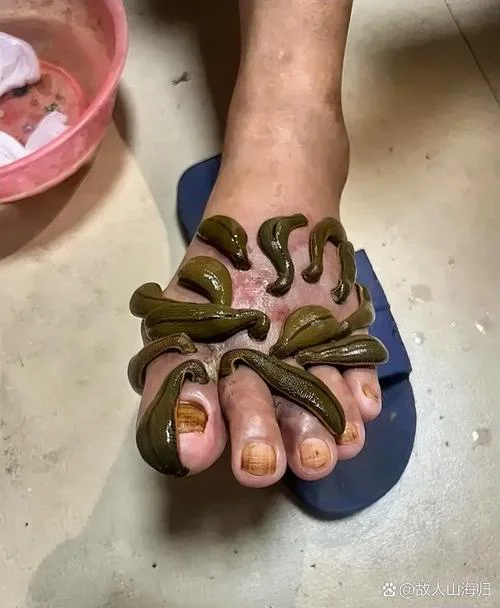 梦到蚂蝗吸自己血_1