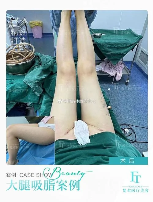 大腿部吸脂手术多少钱_1