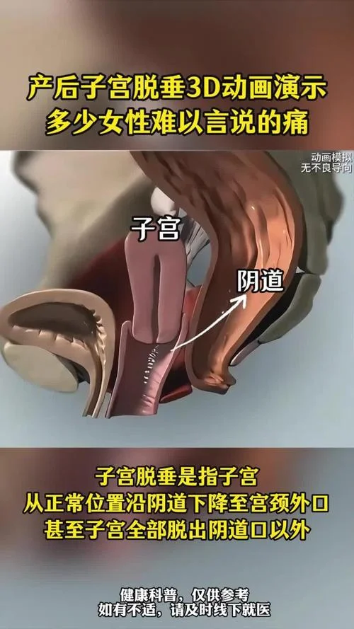 子宫脱垂切除多少钱_1