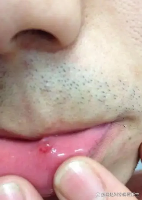 嘴下面起了一个痘痘怎么办-下巴痘痘快速消退