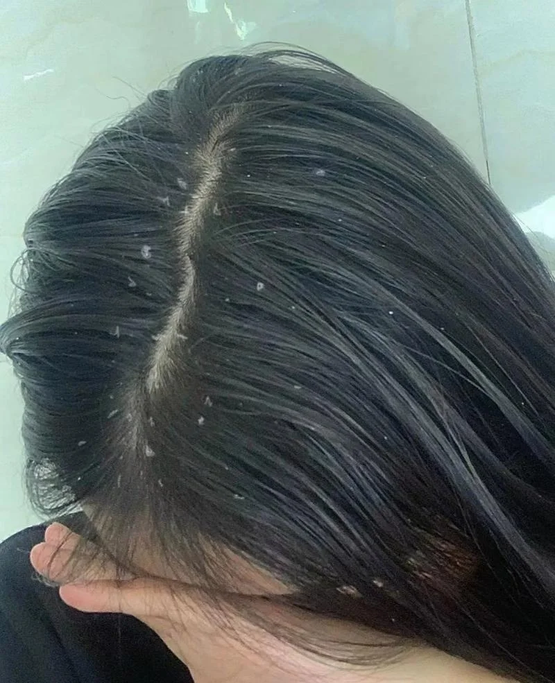 梦见头上掉大块头皮屑_1