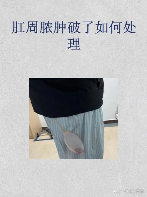 婴儿肛门脓肿怎么办-婴儿肛门脓肿处理方案