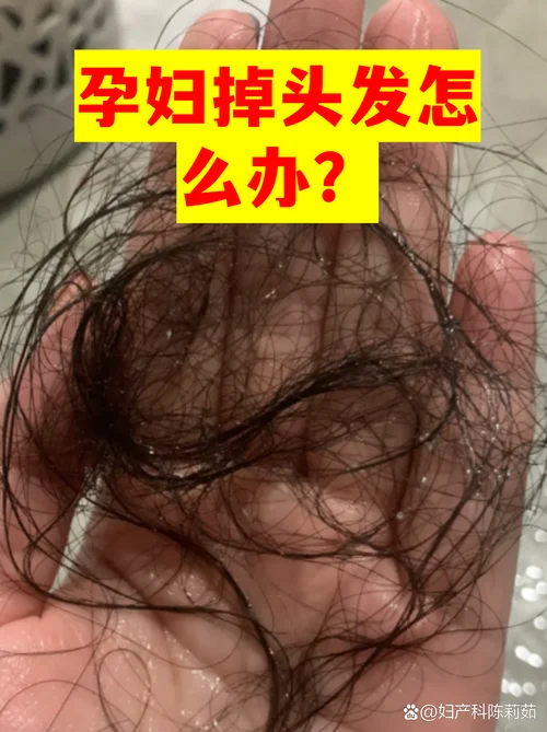 梦见自己大把大把的掉头发是怎么回事-梦境掉发原因解析