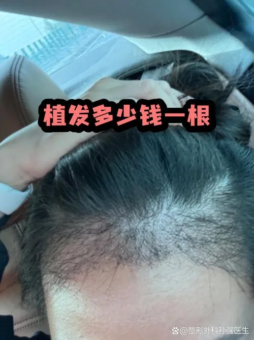 头发种植多少钱单位_2