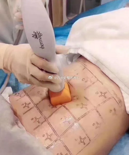 腹部热玛吉多少钱_1