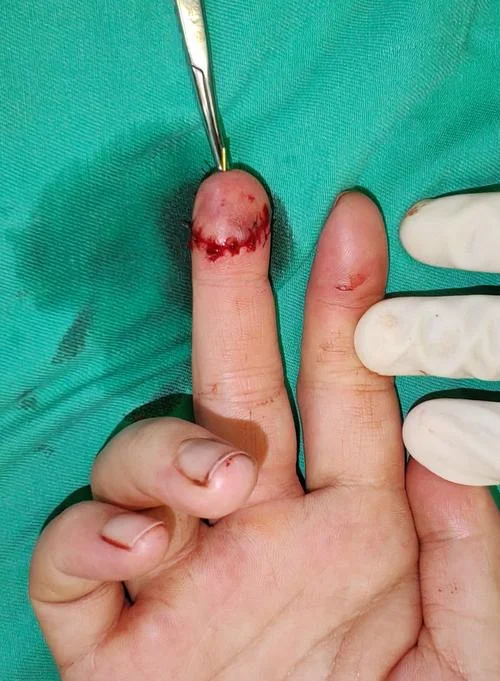 梦见狗咬自己的食指_2